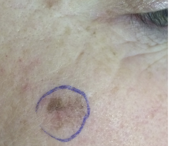 Cosmetic laser treatment can delay melanoma diagnosis and have devastating outcomes