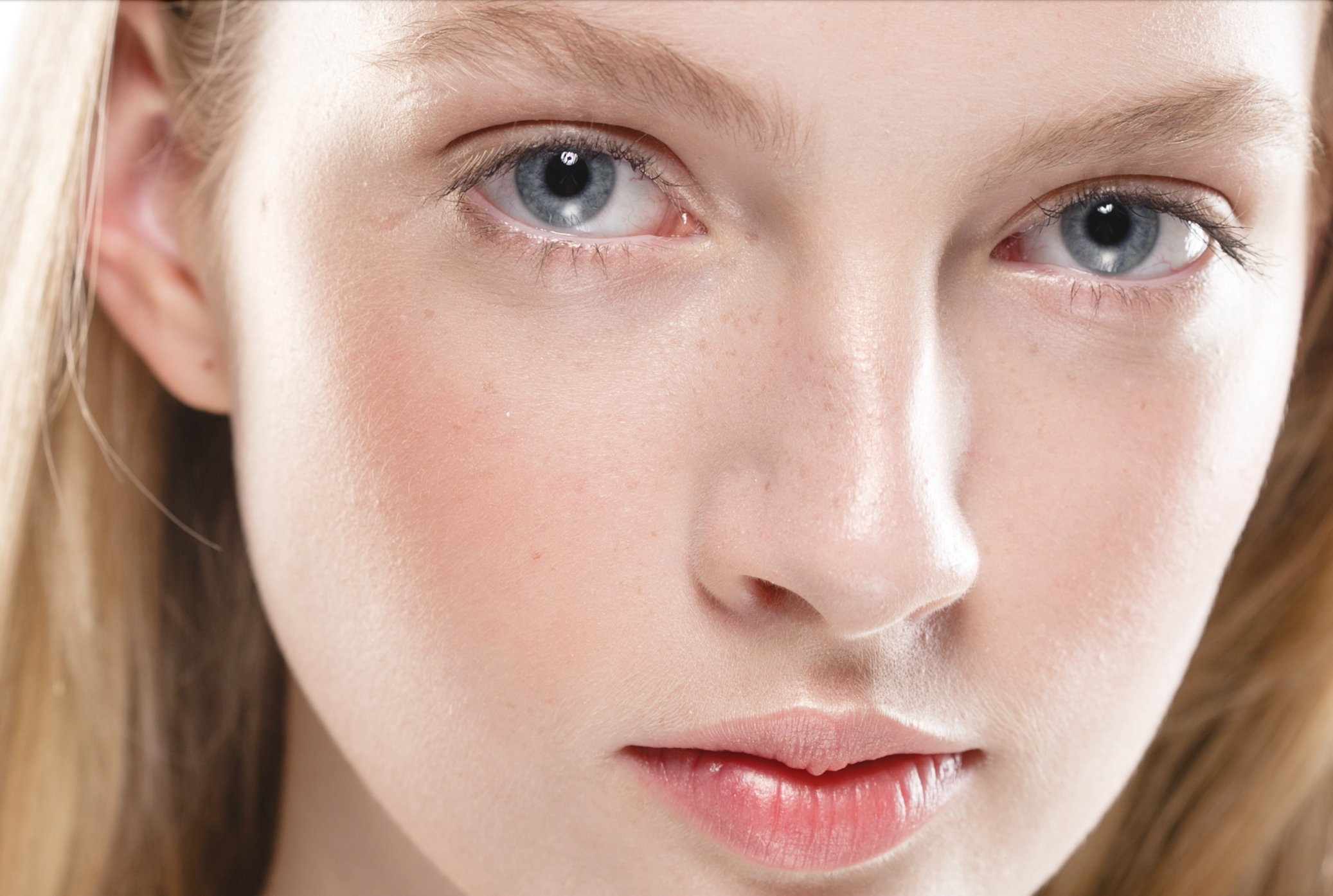 Which laser is best for rosacea?