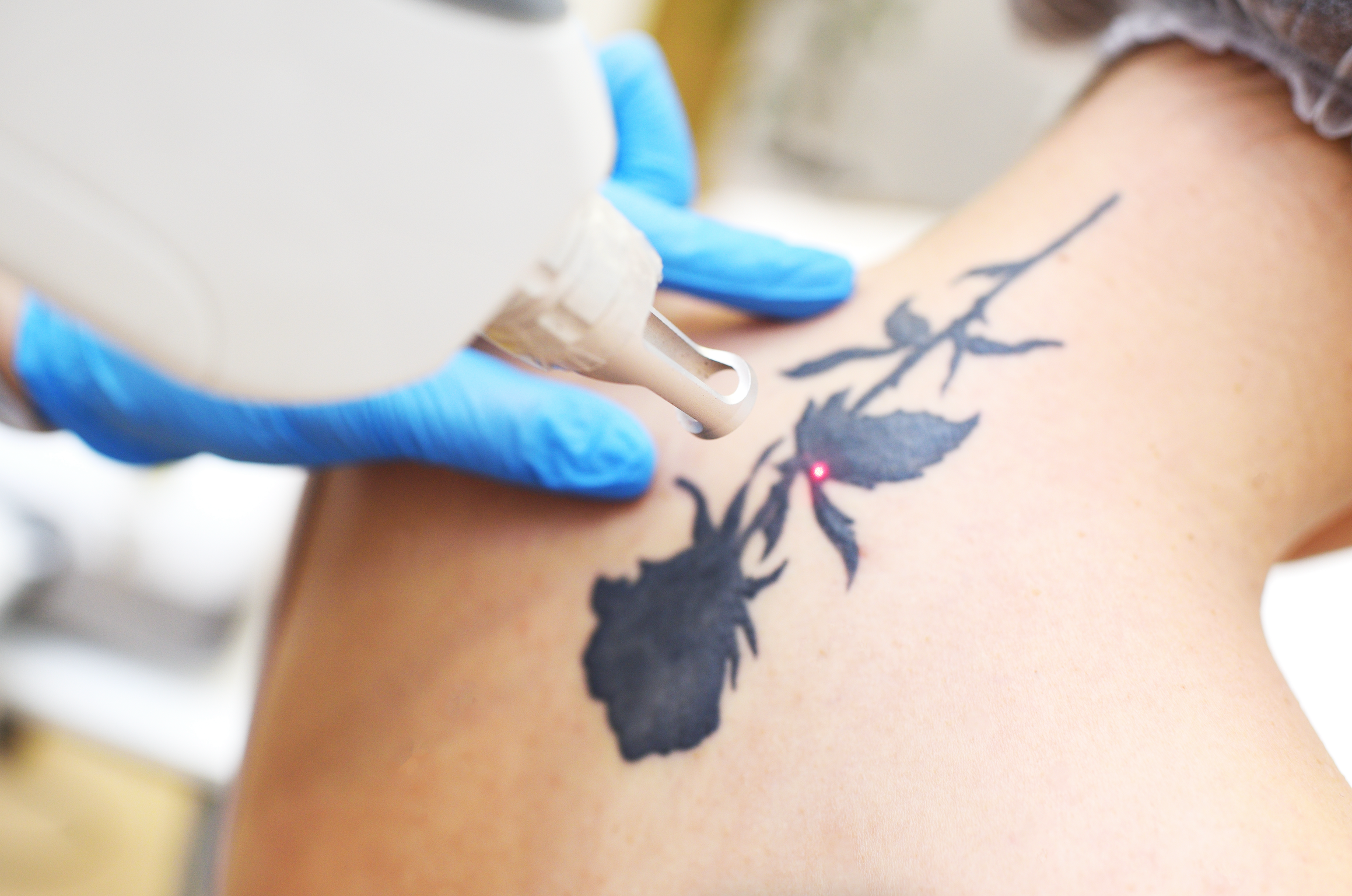 Mastering Tattoo Removal: Advanced Methods and Safety Essentials for Laser Professionals