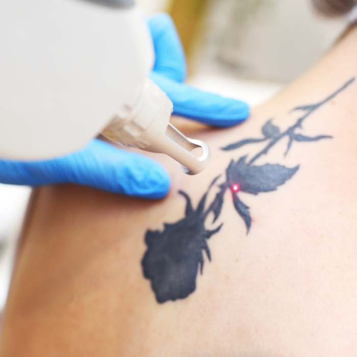 Mastering Tattoo Removal: Advanced Methods and Safety Essentials for Laser Professionals