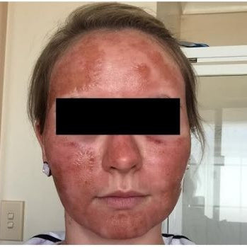 Excruciating pain, scarring, infection and possible blood borne virus contraction! Urgent calls for standards (again)...