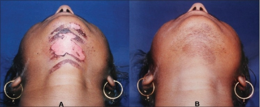 When do you report a burn to your doctor after a less than perfect laser or IPL treatment?