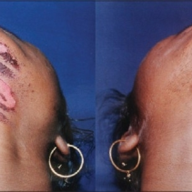 When do you report a burn to your doctor after a less than perfect laser or IPL treatment?