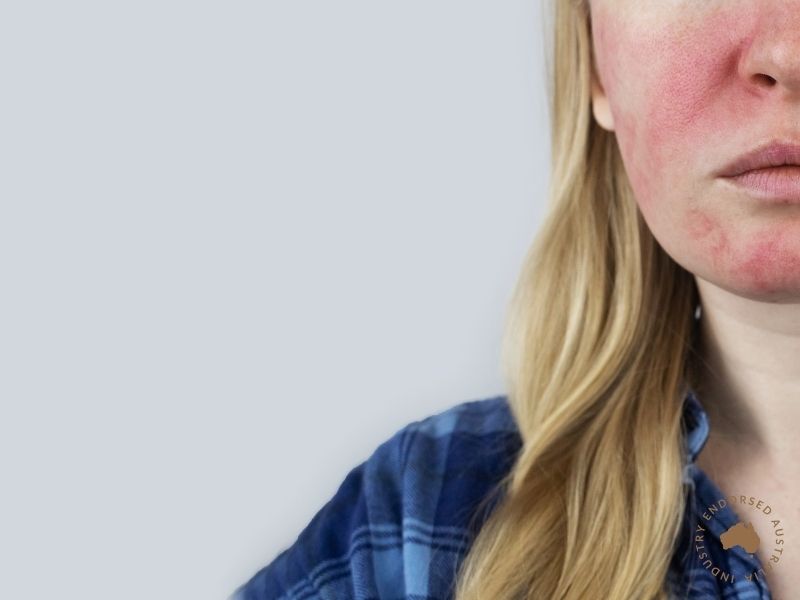 Skin Rejuvenation - Superficial Capillary Reduction Laser/IPL (Short Course)
