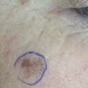 Cosmetic laser treatment can delay melanoma diagnosis and have devastating outcomes