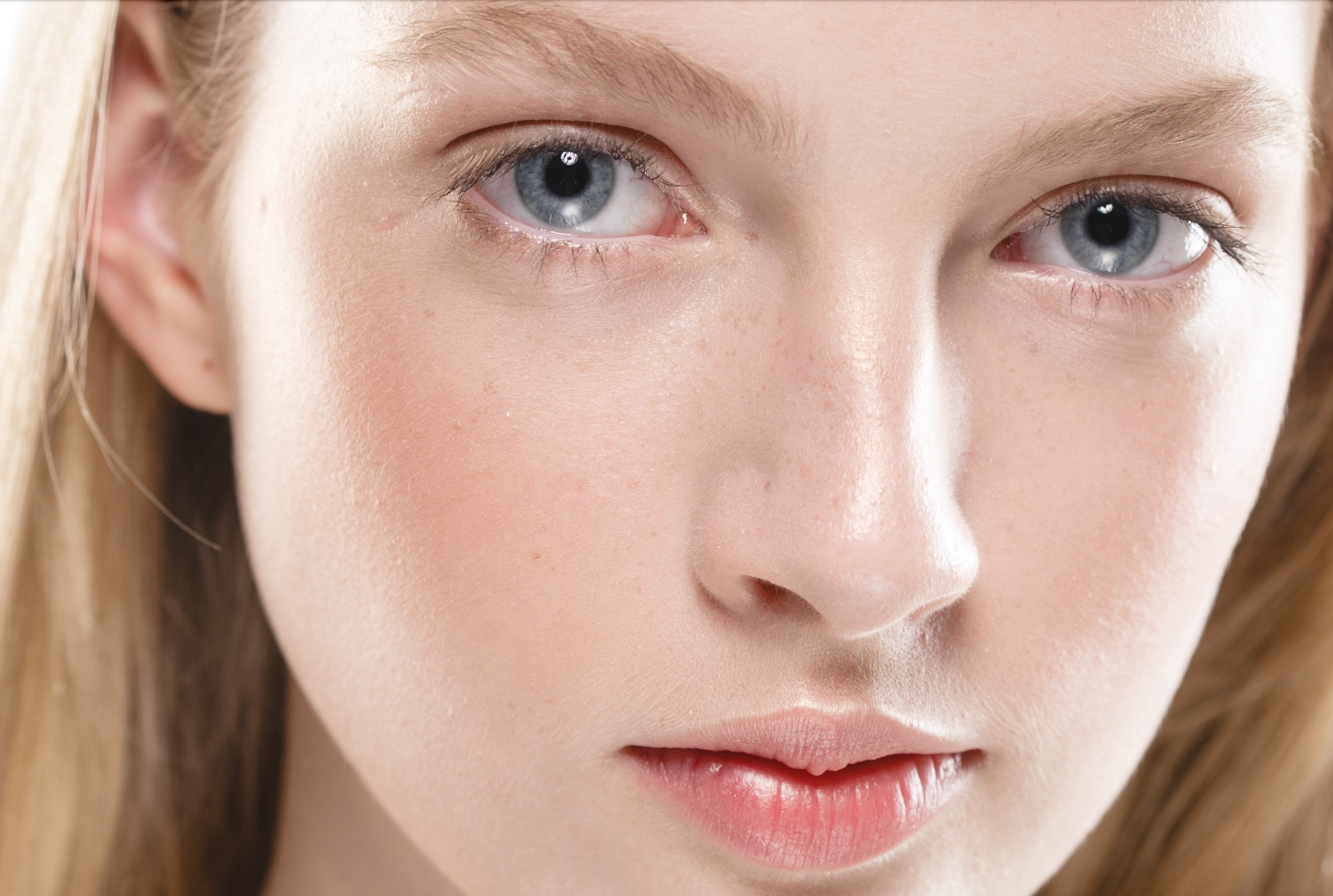 Which laser is best for rosacea?
