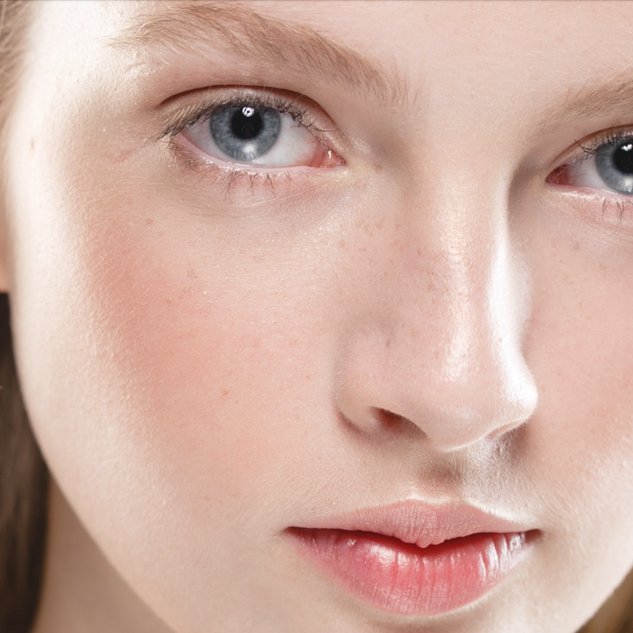 Which laser is best for rosacea?