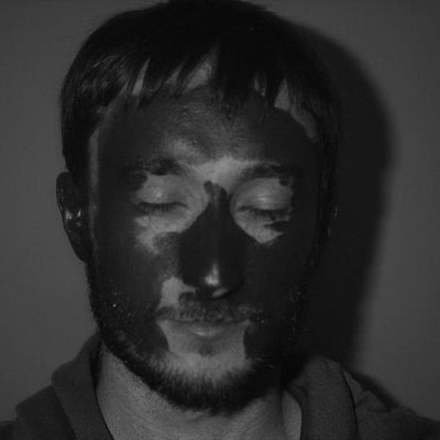 Sunscreen essential post laser/IPL but it needs to be applied correctly