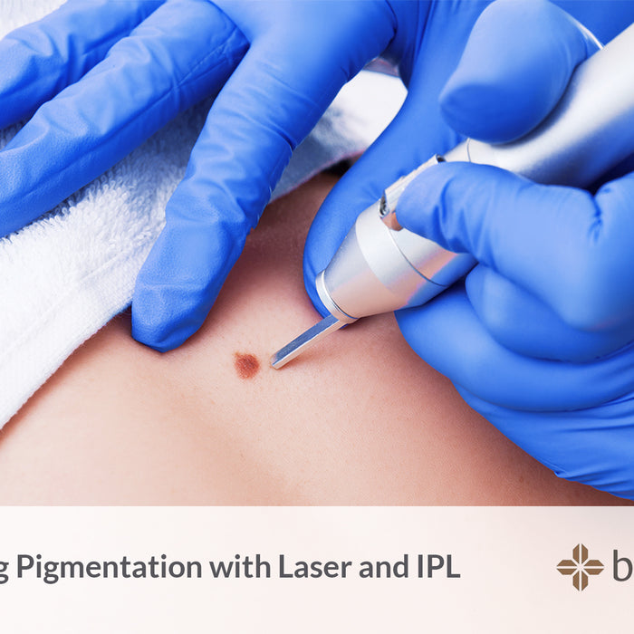 Pigmentation with Laser IPL