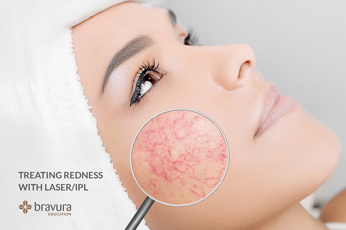 Treating Redness with Laser/IPL — Bravura Education