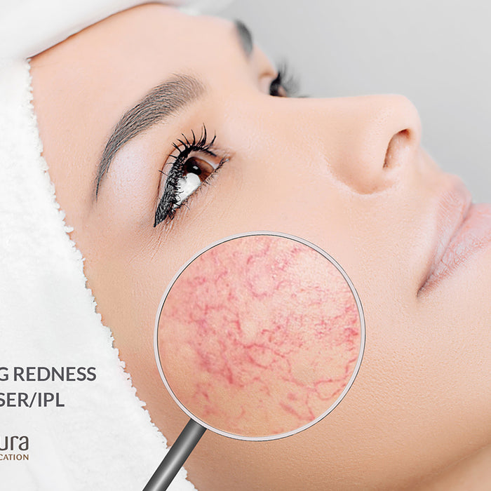Redness with Laser IPL