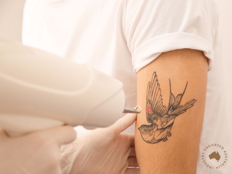 Laser Tattoo Removal (Short Course)