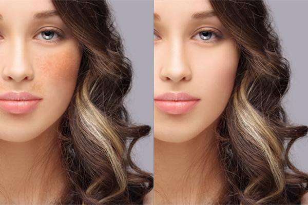 Medical Grade Chemical Skin Peels